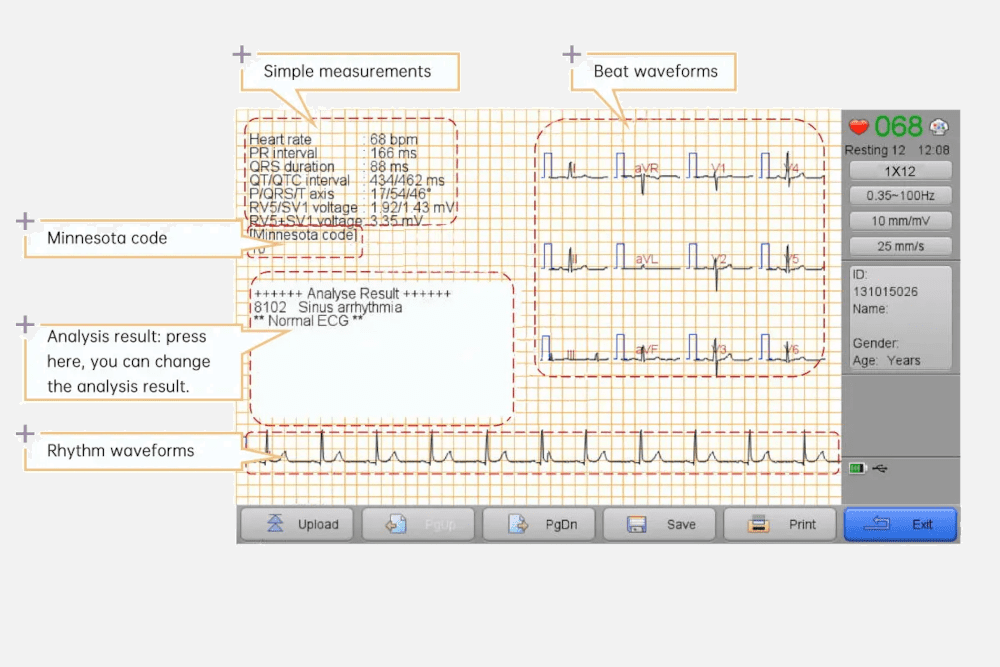 ECG analysis program